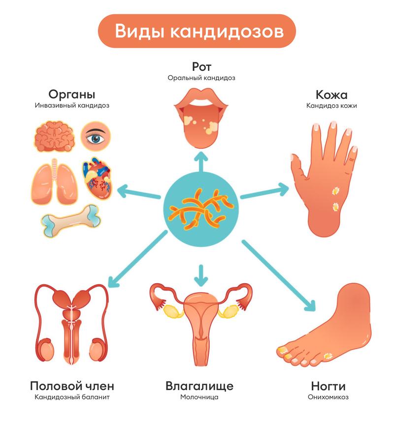 разновидности кандидоза