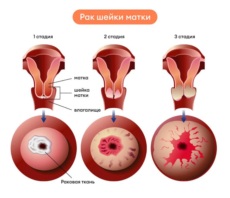 Кольпоскопия при диагностике рака