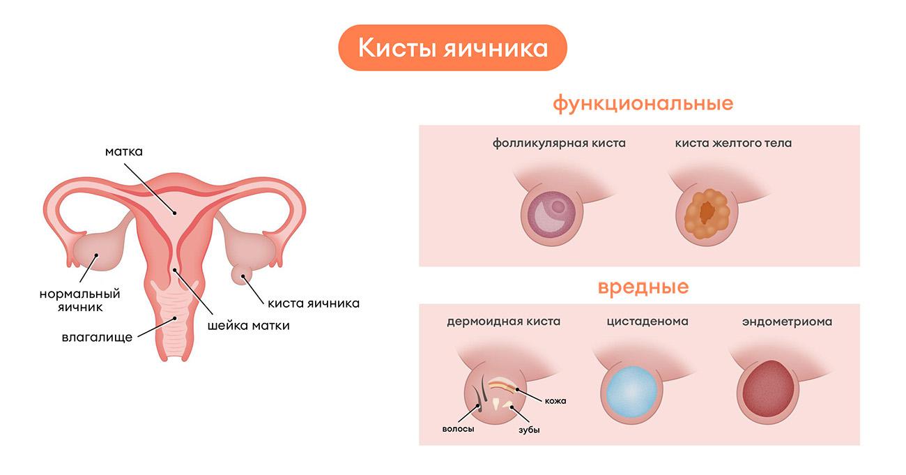 Киста яичника: причины возникновения, диагностика и лечение