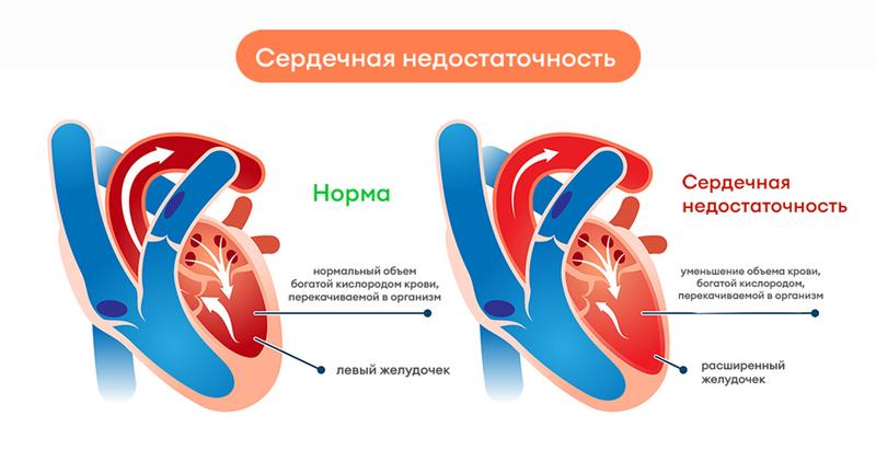 Сердечная недостаточность: симптомы и методы лечения