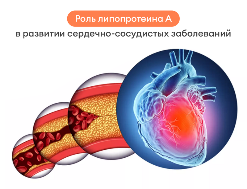 Гиперхолестеринемия (повышенный уровень холестерина)